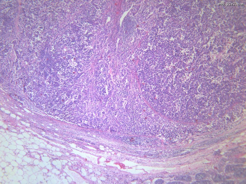 淋巴结内转移癌