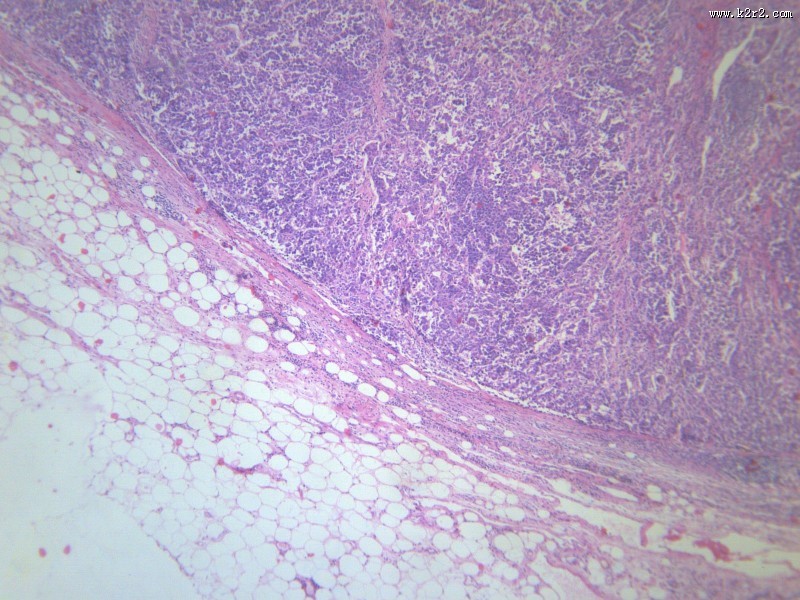 淋巴结内转移癌