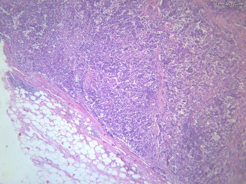 淋巴结内转移癌
