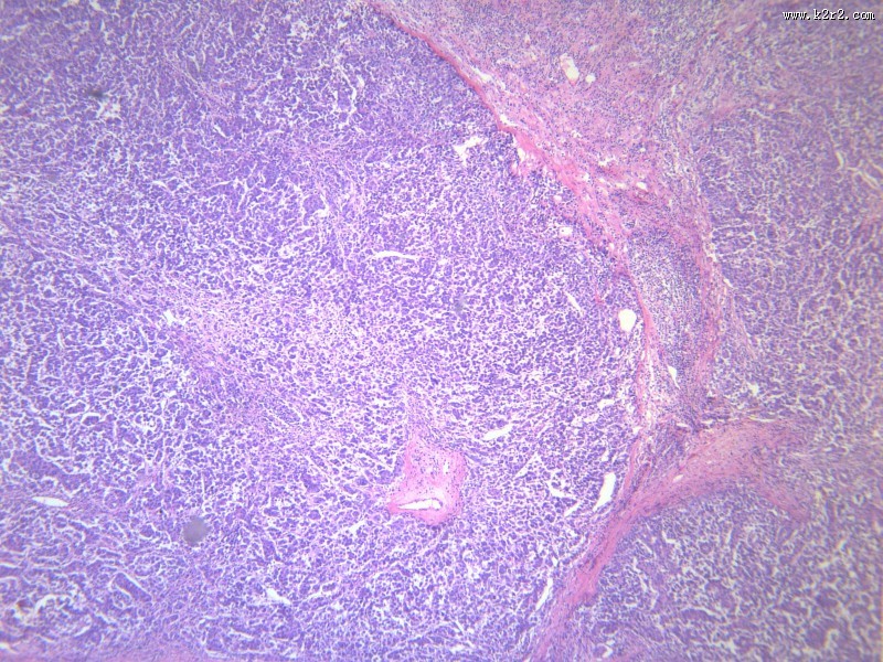 淋巴结内转移癌