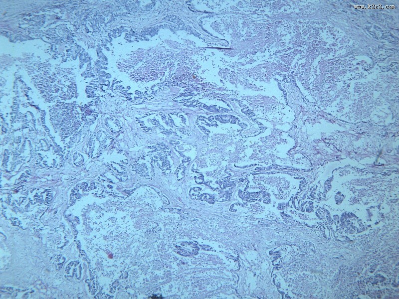 腺癌肝转移大全