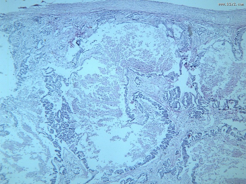 腺癌肝转移大全