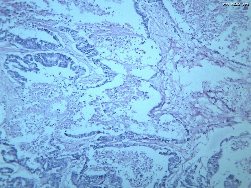 腺癌肝转移大全