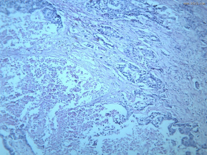 腺癌肝转移大全