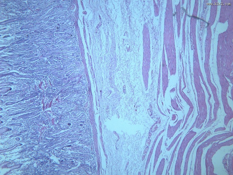 慢性萎缩性胃炎大全