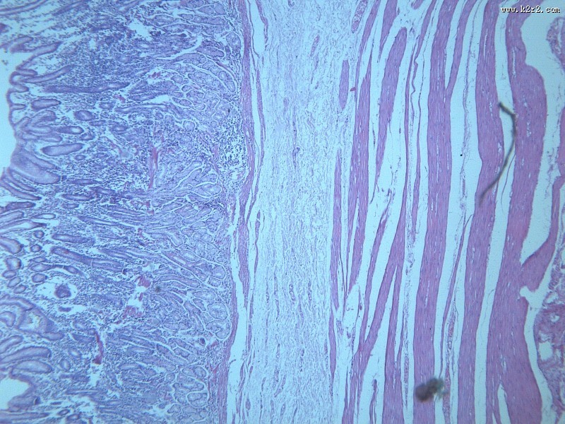 慢性萎缩性胃炎大全