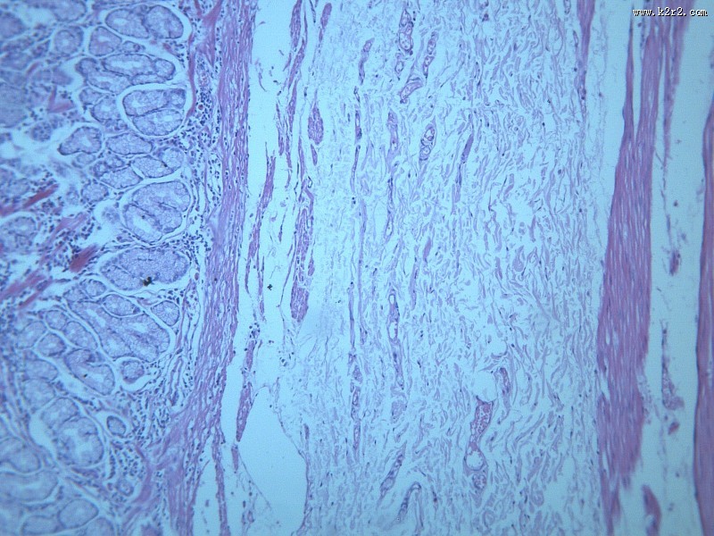 慢性萎缩性胃炎大全