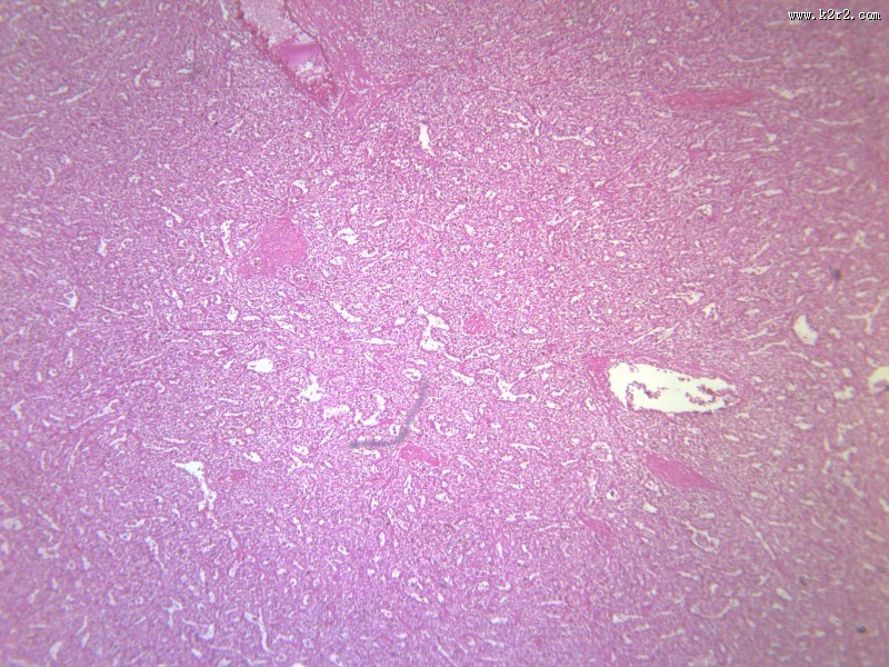 脾被膜玻璃样变