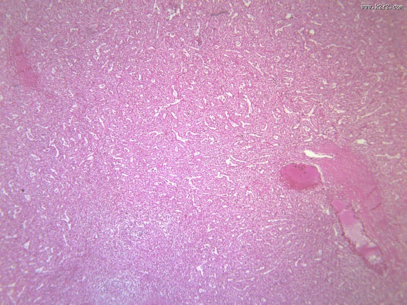 脾被膜玻璃样变