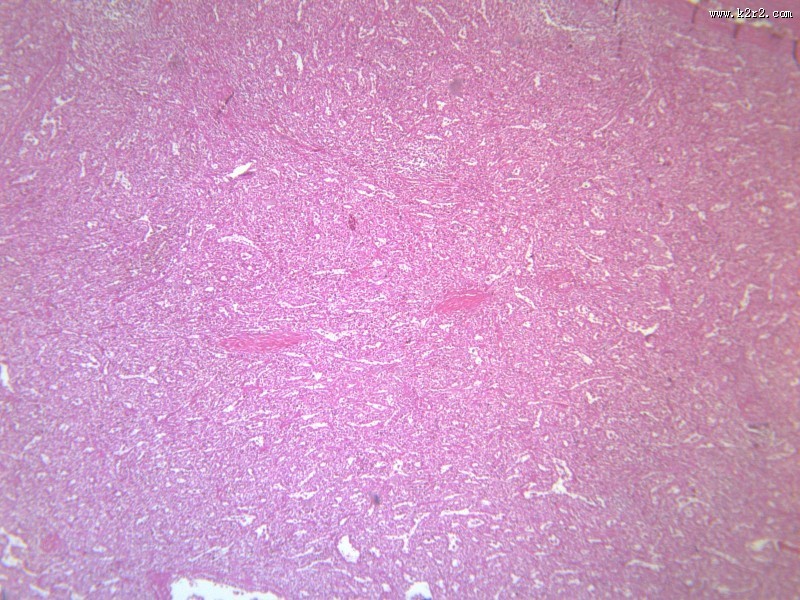 脾被膜玻璃样变