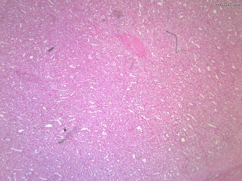 脾被膜玻璃样变