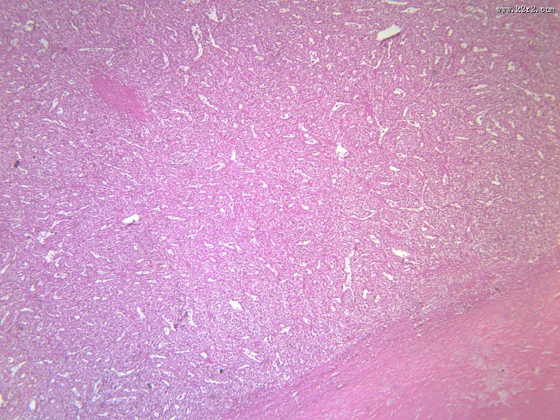 脾被膜玻璃样变
