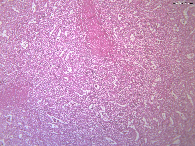 脾被膜玻璃样变