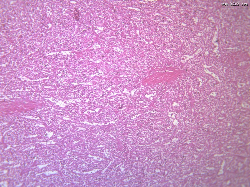 脾被膜玻璃样变