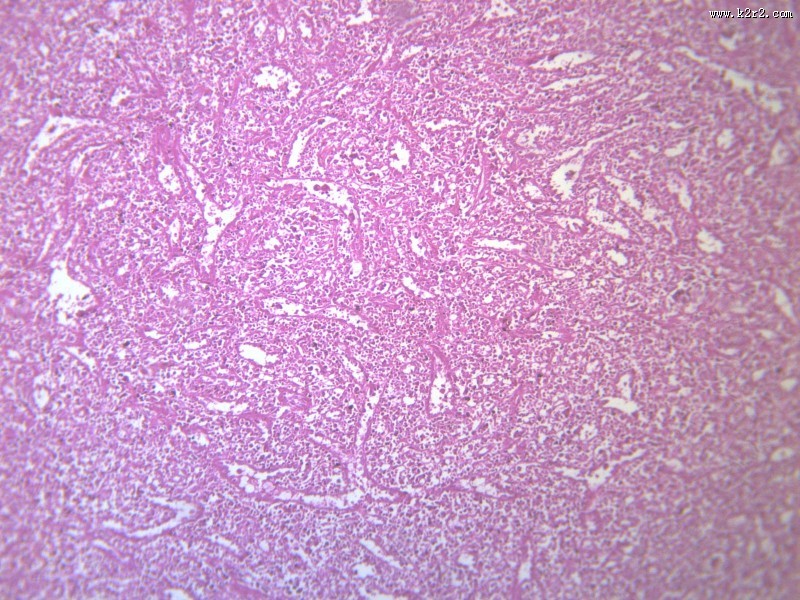 脾被膜玻璃样变