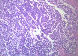 淋巴结内转移癌