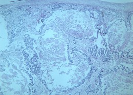 腺癌肝转移大全