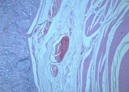 慢性萎缩性胃炎大全