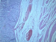 慢性萎缩性胃炎大全