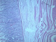 慢性萎缩性胃炎大全