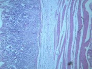 慢性萎缩性胃炎大全