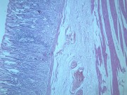 慢性萎缩性胃炎大全