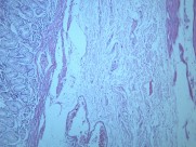 慢性萎缩性胃炎大全